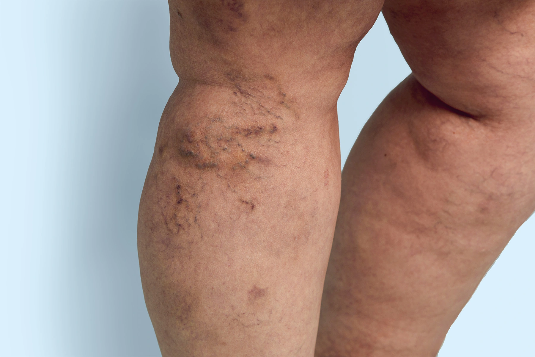 75% of POTS patients have venous insufficiency. Discover the proven connection, why it matters, and how treating vein problems may improve POTS symptoms.
