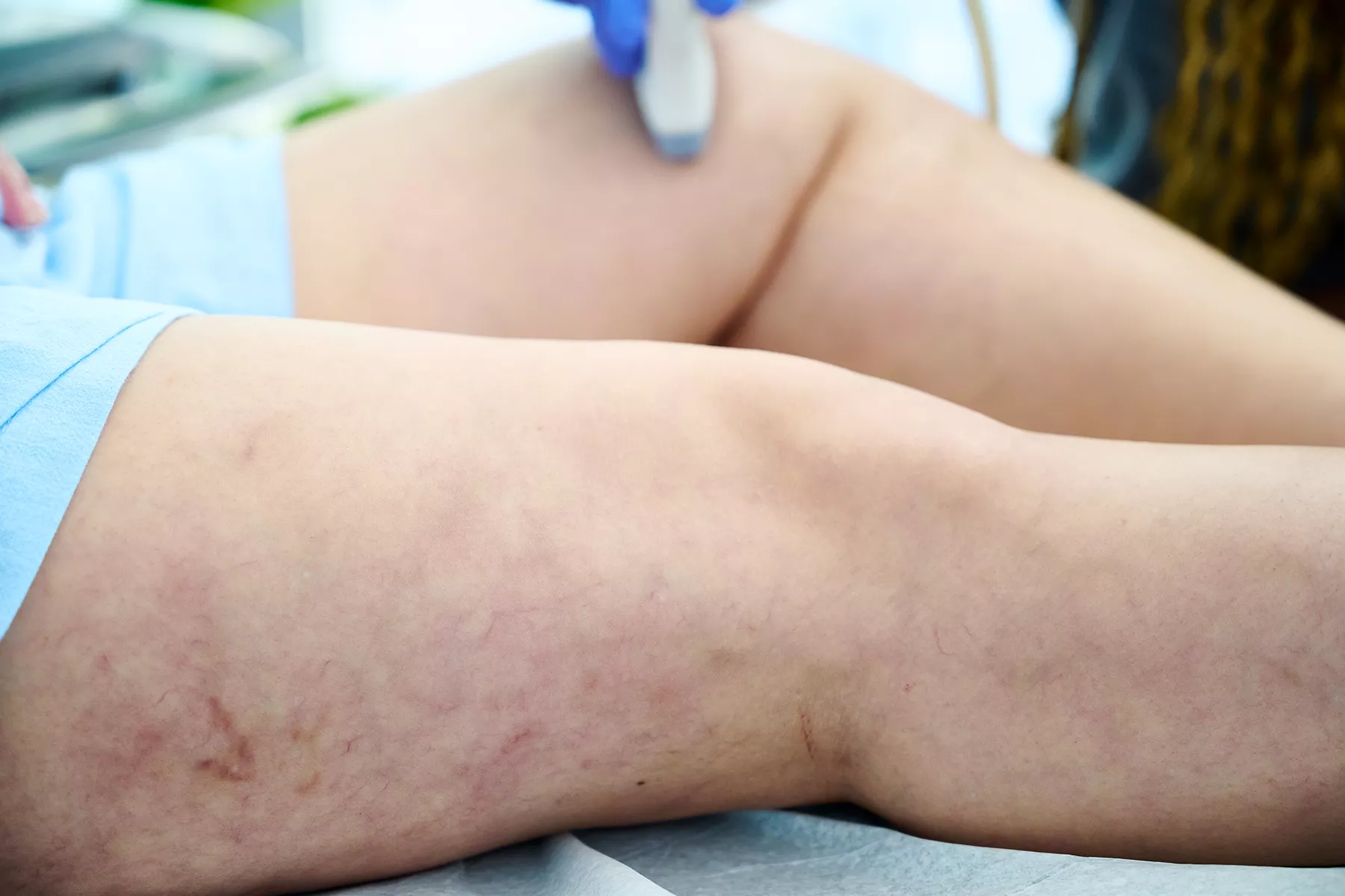 Explore how the Venous Clinical Severity Score (VCSS) provides vein specialists a dynamic, detailed tool to track chronic venous disease severity, guide treatment, and monitor patient progress over time.